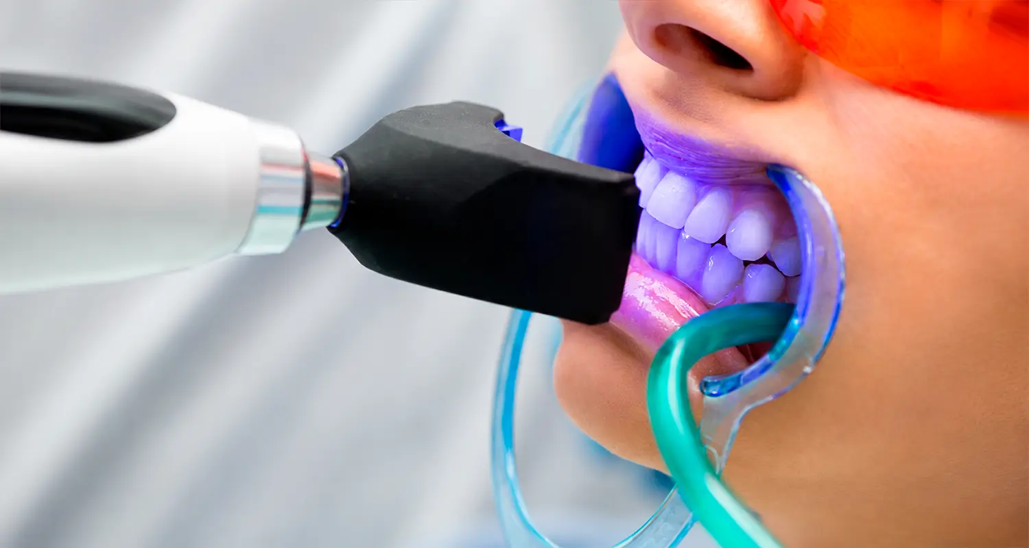 Clareamento dental em Lages/SC