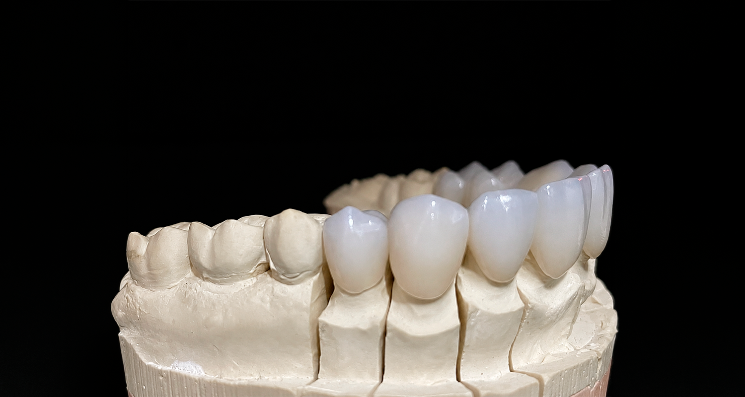 Coroa de cerâmica – facetas e lentes de contato